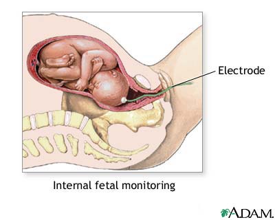 Electrodul pătrunde acolo unde nimic n-ar trebui să intre: în uter, în sacul amniotic, în copil!
